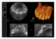 歯科用CT撮影画像
